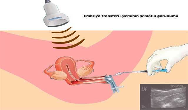 embriyo transferi1