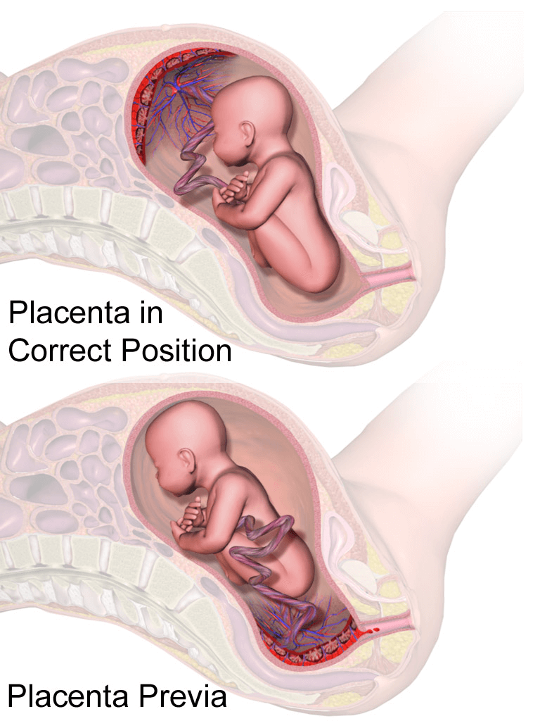 Plasenta doğru pozisyonda, üst - Plasenta previa, alt 
