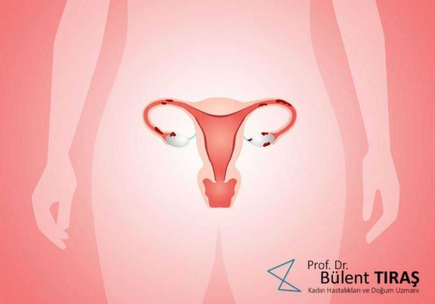 endometriozis