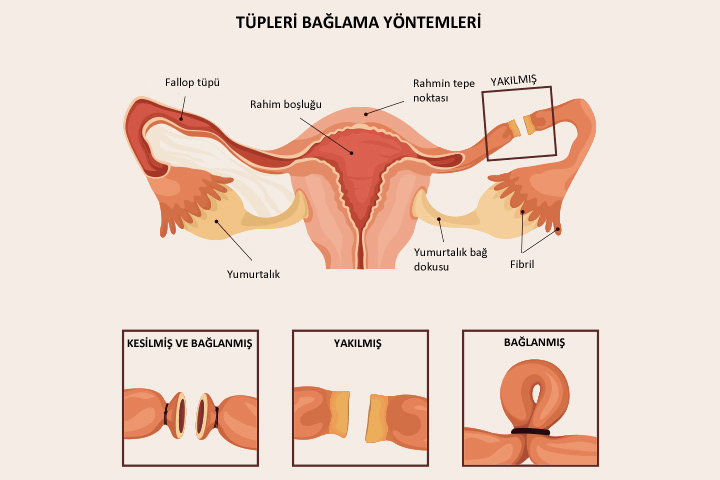 tüp bağlatma yöntemleri nelerdir