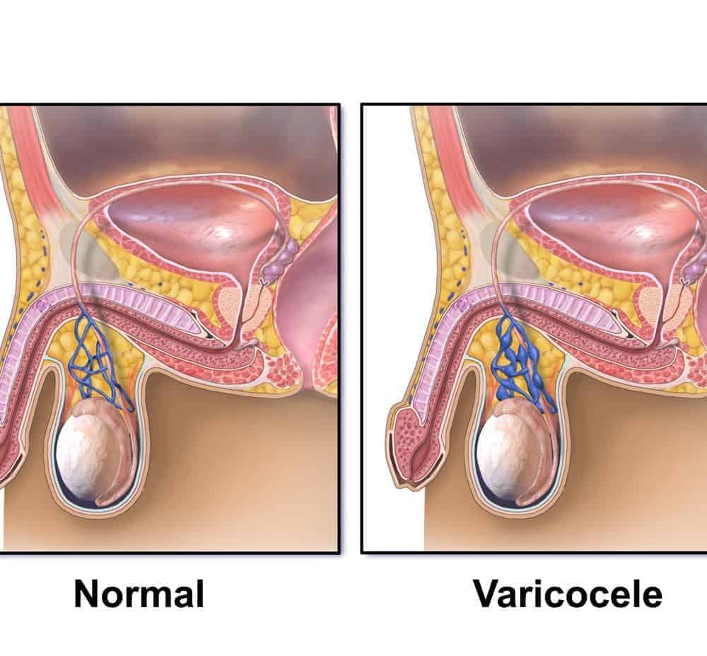 varikosel-6