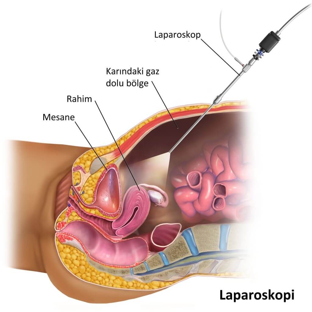 Laparoskopi işlemi nasıl yapılır