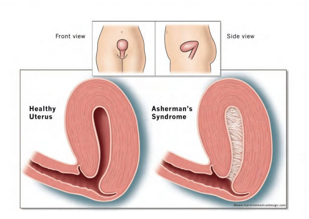 Asherman Sendromu