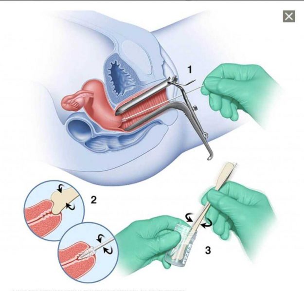 pap-smear