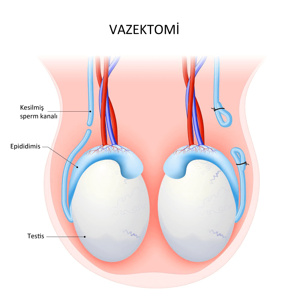 vazektomi nedir