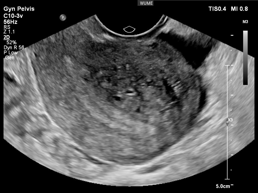 Adenomiyoz ultrason görüntüsü