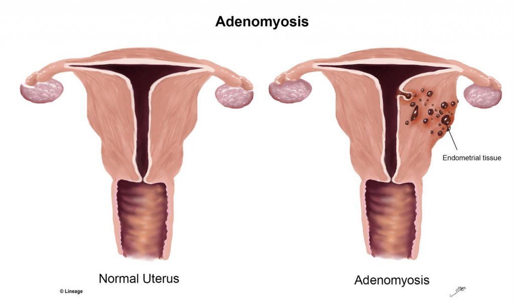 Adenomyozis