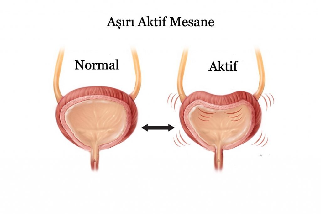 Aşırı aktif mesane nedir?