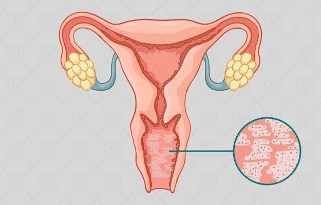 bakteriyel-vajinozis