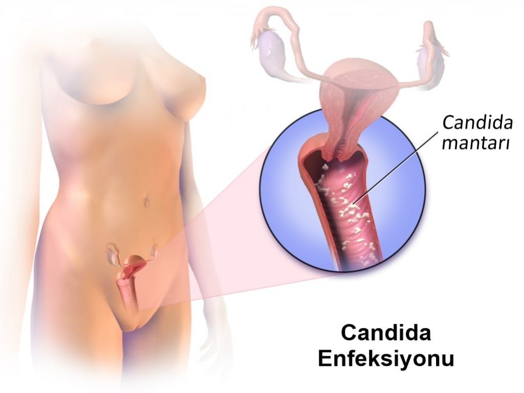 candida enfeksiyonu 