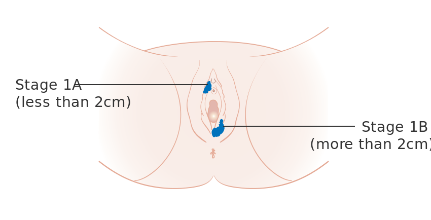 Vulva kanseri evre 1 a ve 1 b 