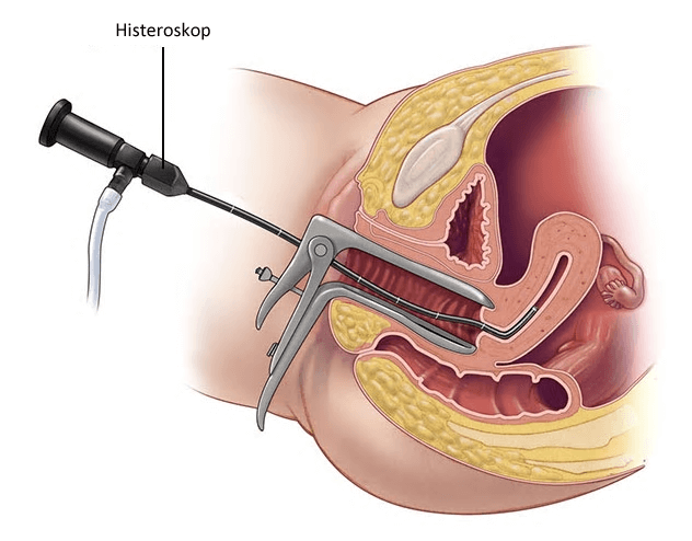 Histeroskopi sırasında doktor ince, ışıklı bir cihazı (histeroskop) rahmin içini görüntülemek için kullanır. 