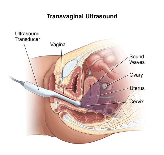 transvajinal ultraon