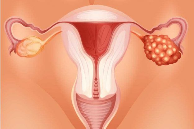 over-yumurtalik-kanseri Yumurtalık Kanseri