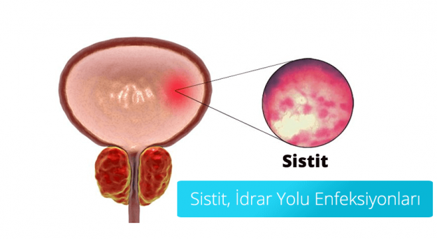 cystitit-sistit-tedavisi sistit